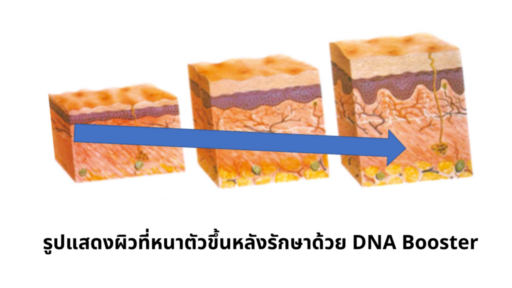 รูปแสดงผิวที่หนาตัวขึ้นหลังรักษาด้วย DNA Booster